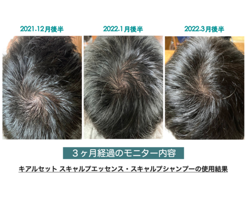 スキャルプ画像