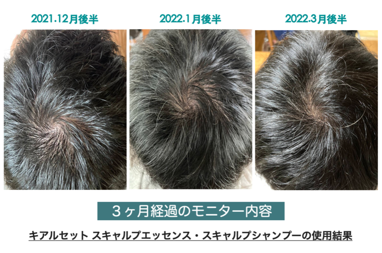 スキャルプ画像